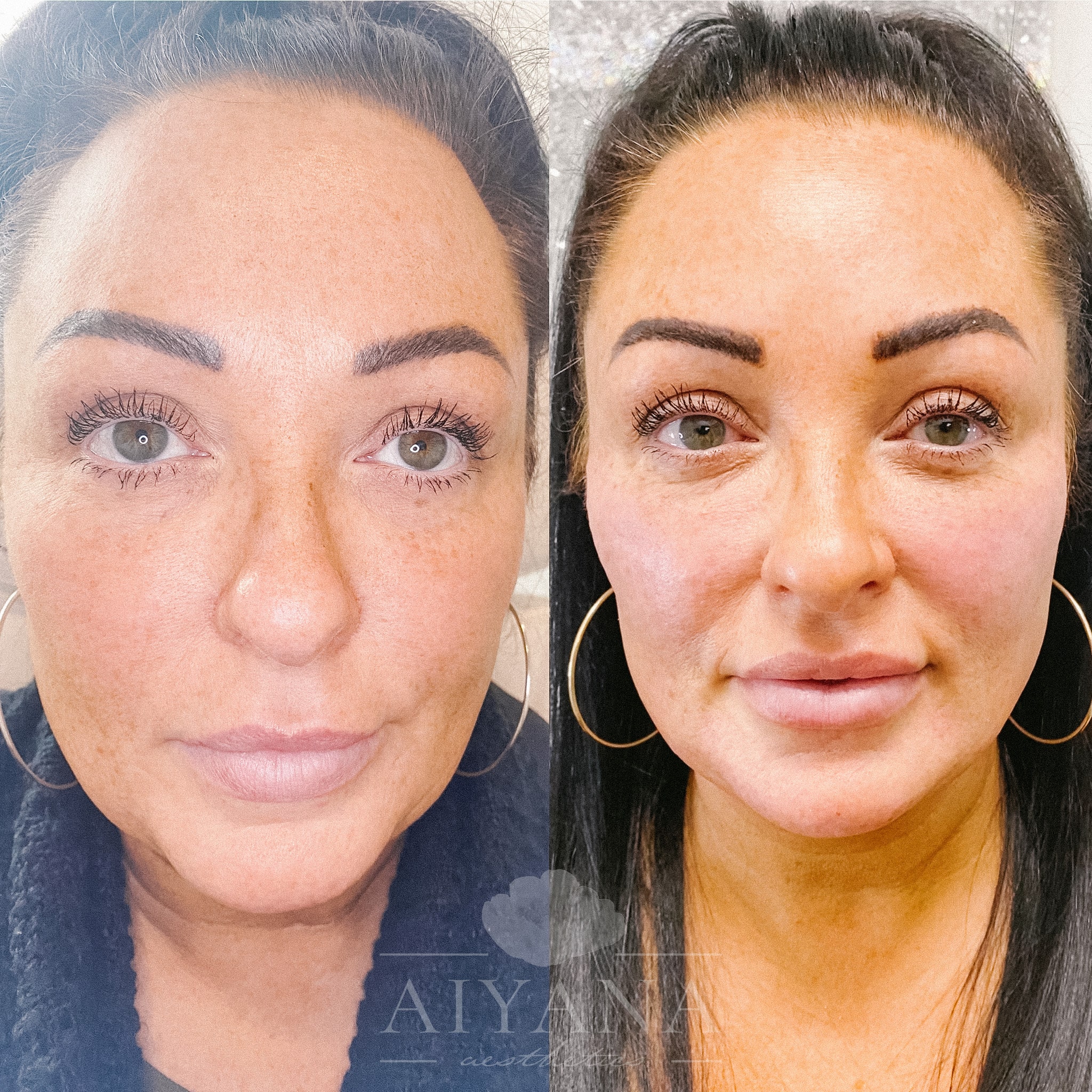 Before & After Gallery | Molalla, OR - Aiyana aesthetics