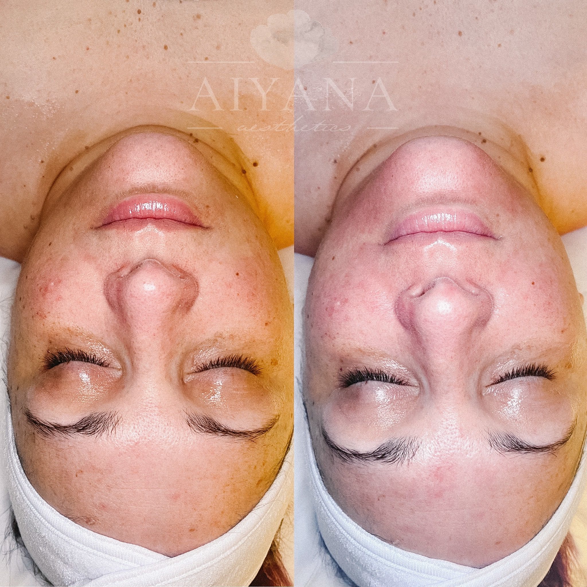 Before & After Gallery | Molalla, OR - Aiyana aesthetics