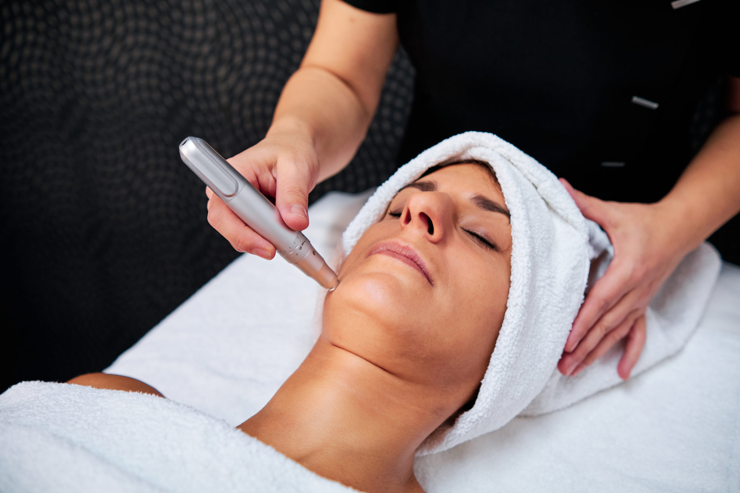 Is Microneedling Safe And Effective For Acne Scars
